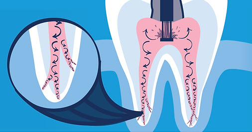 GentleWave® Procedure