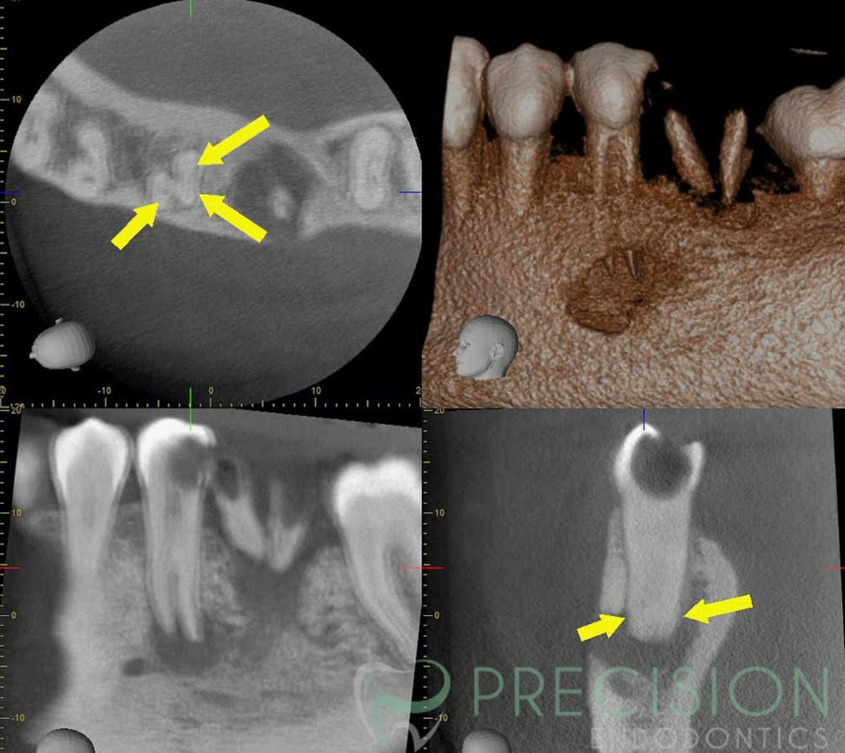 Root Canal Retreatment
