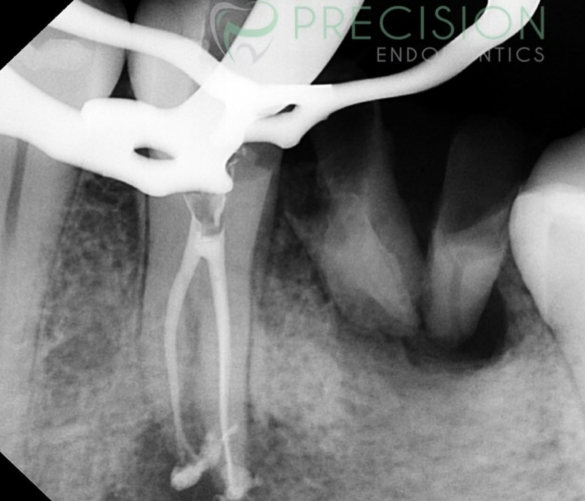 Root-End Surgery/Apicoectomy