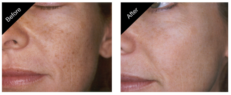 Elos Laser Photofacial