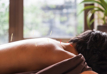 Acupuncture