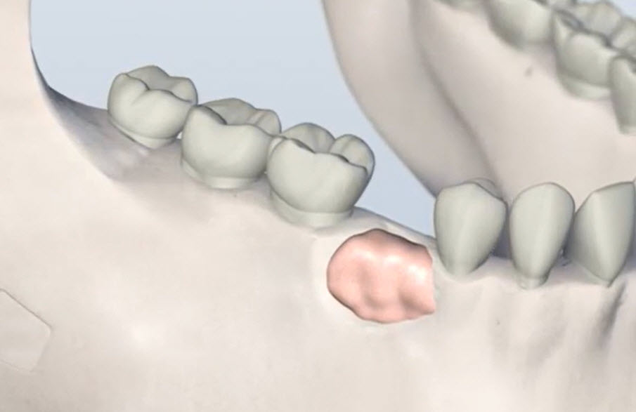 Bone Grafting