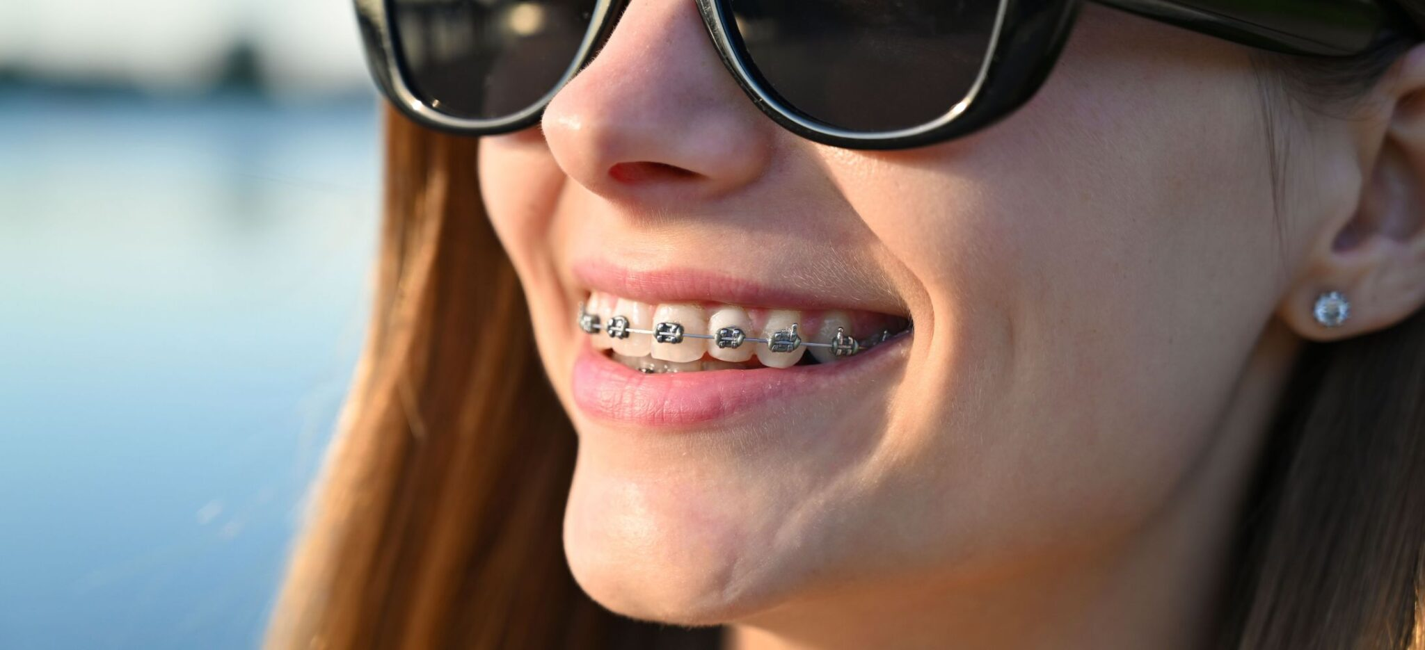 Metal Braces