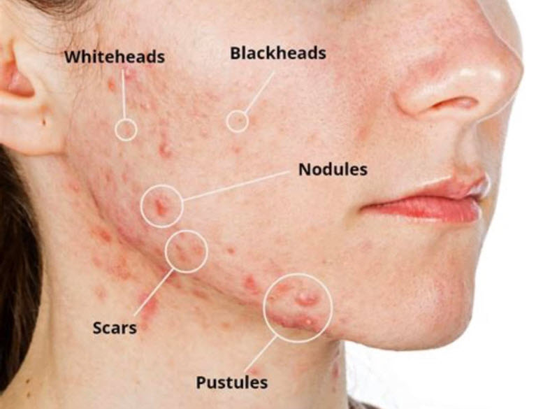 Facial