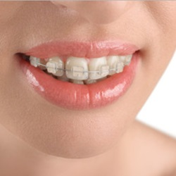 Ceramic Brace