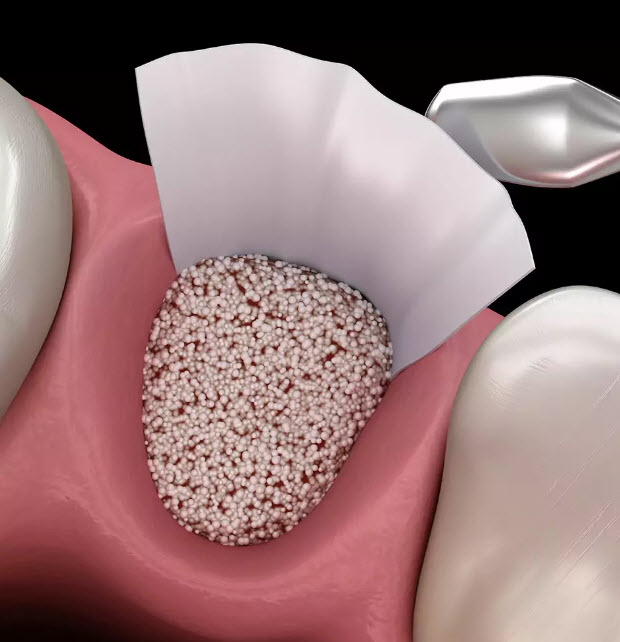 Bone Grafting