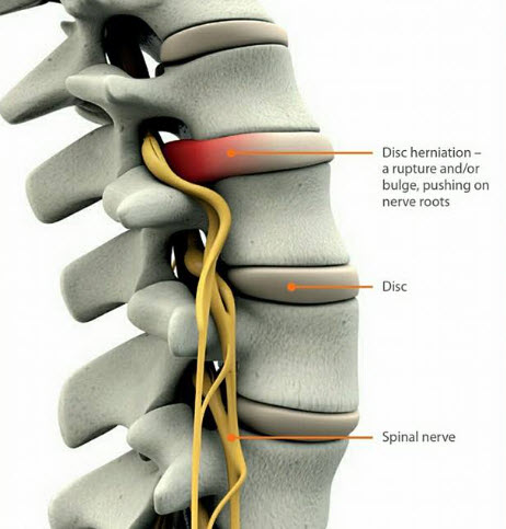 Trigger Point Injections