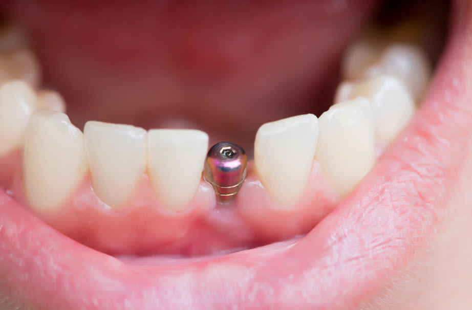 Implant