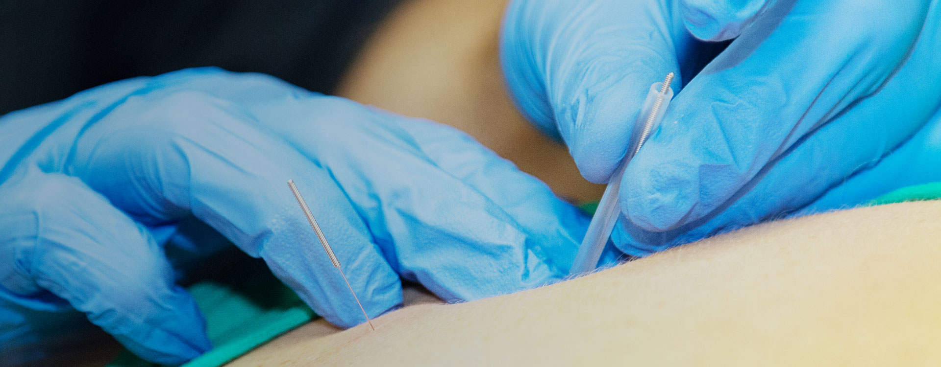 Dry Needling Physical Therapy