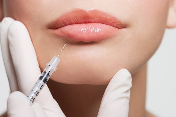 Lip Filler Injections