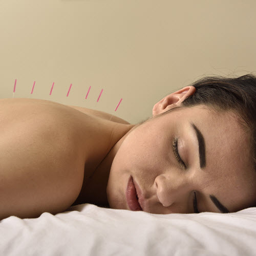 Acupuncture
