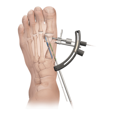 Foot and Ankle