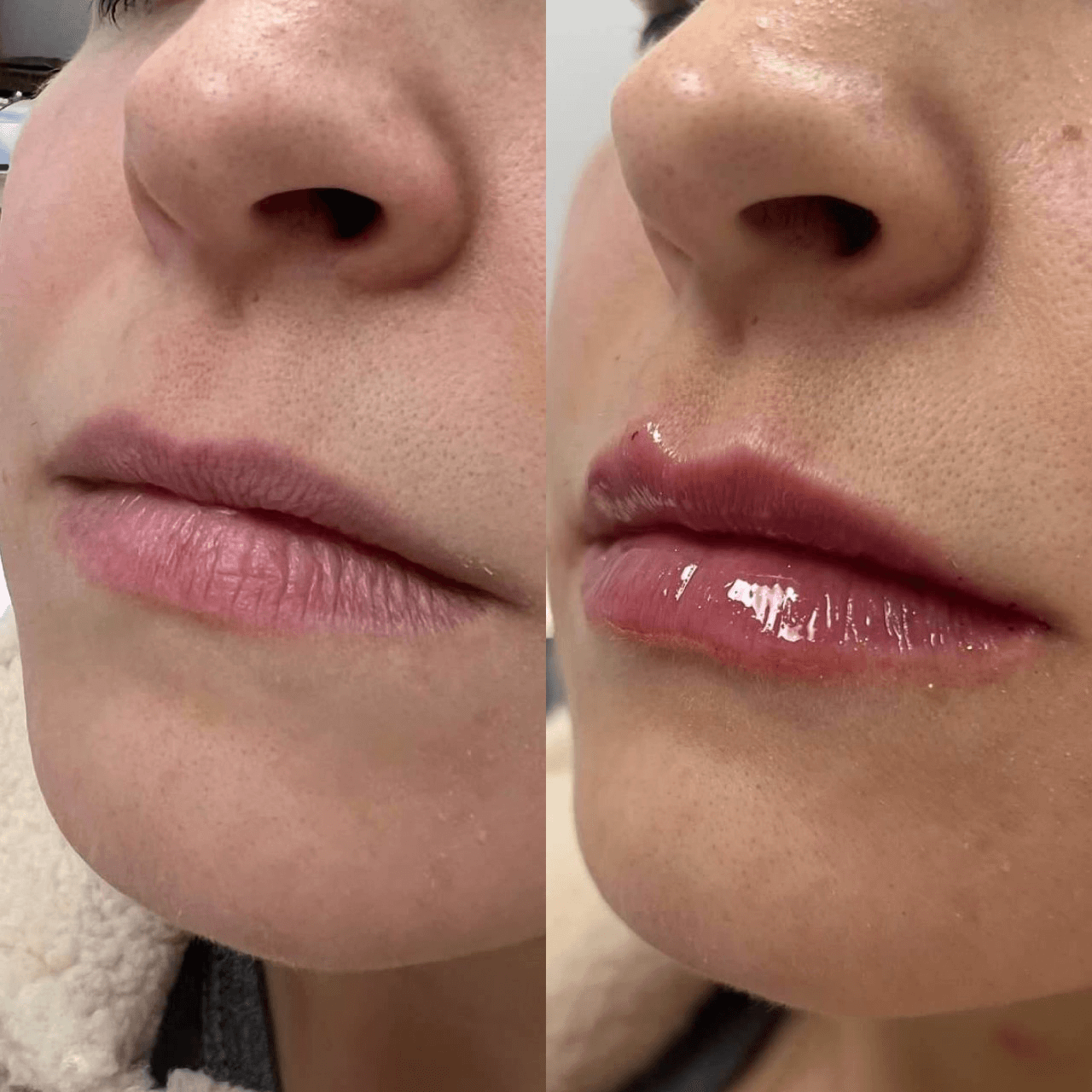 Dermal Fillers
