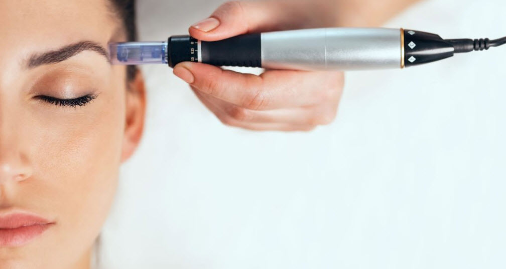 Microneedling 