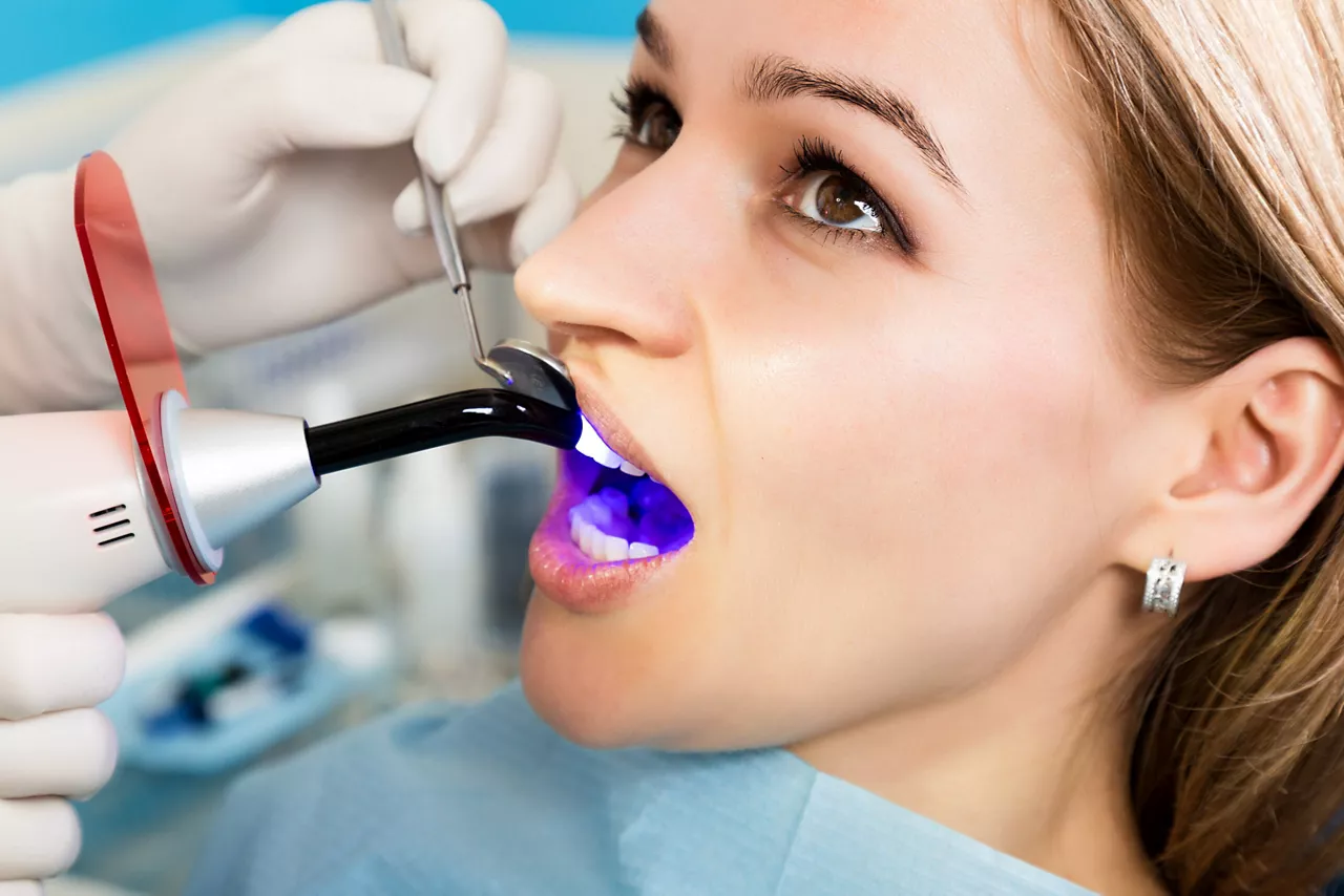 Dental Sealants