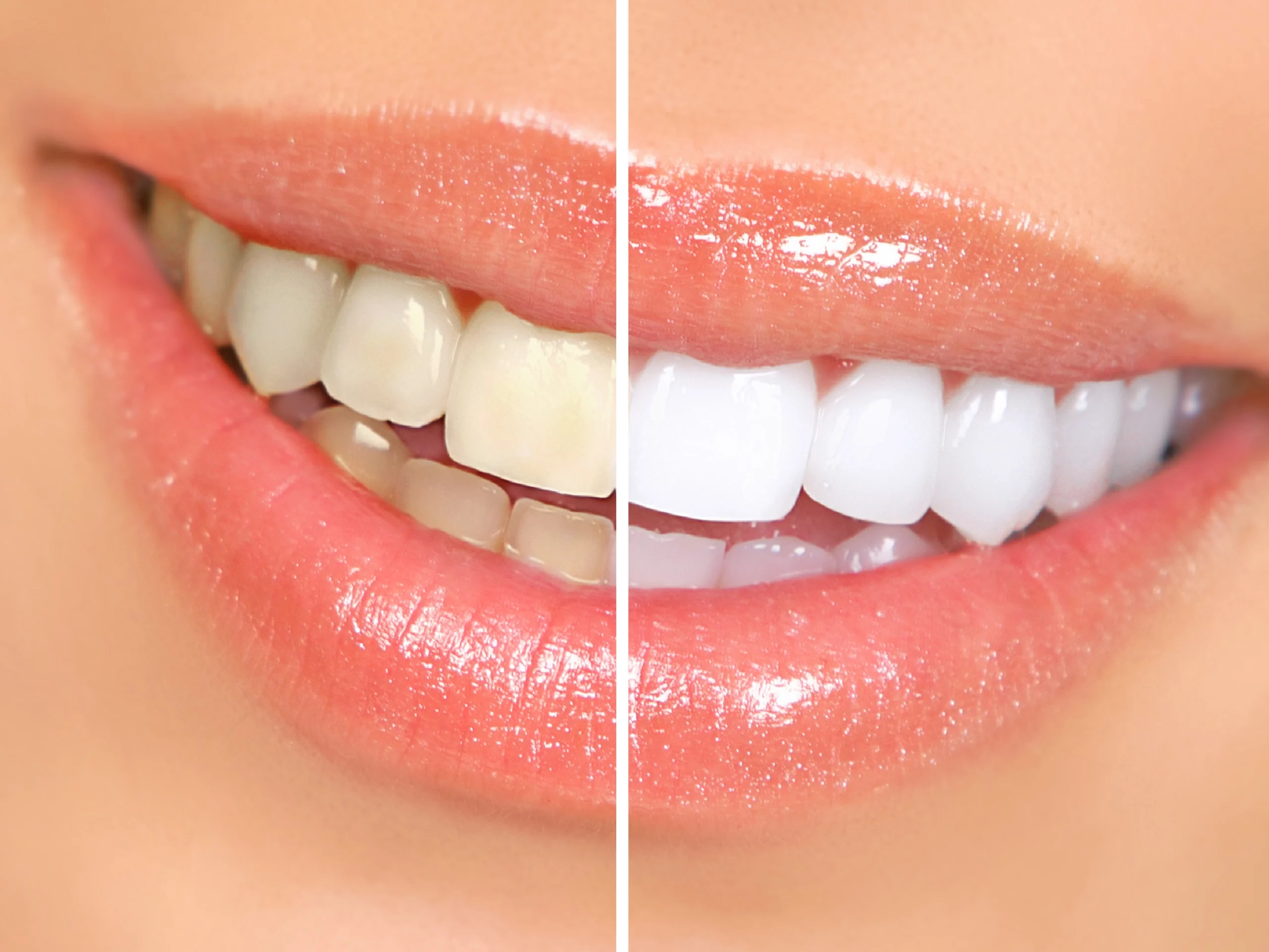 Teeth Whitening