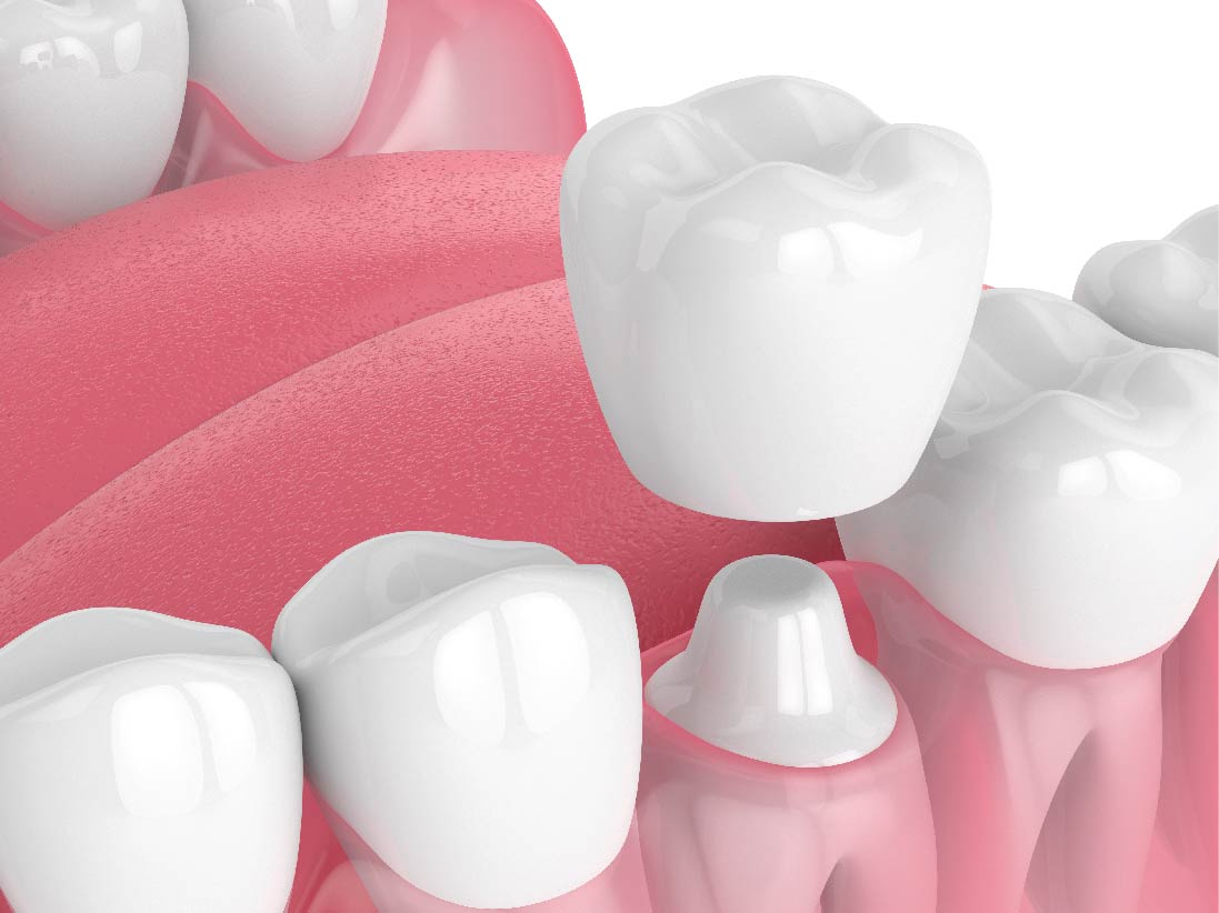 Dental Crowns