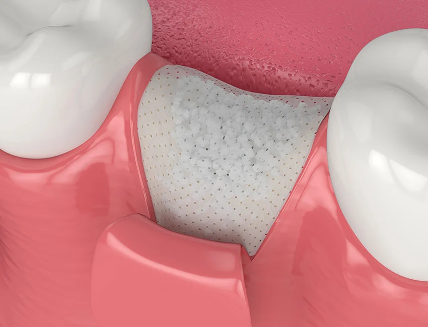 Bone Graft 