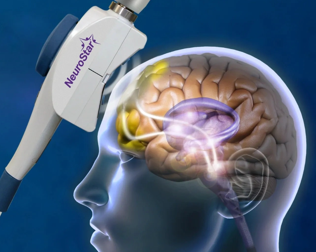 NeuroStar Advanced Therapy (TMS)