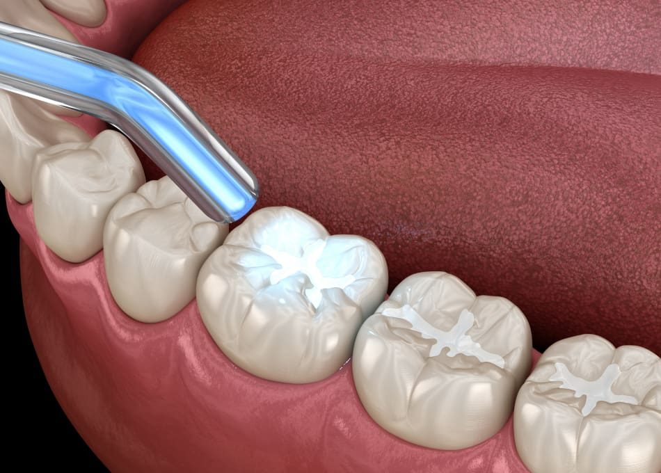 Dental Fillings