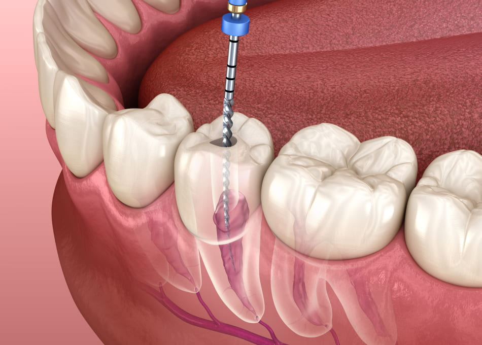 Root Canal Treatment