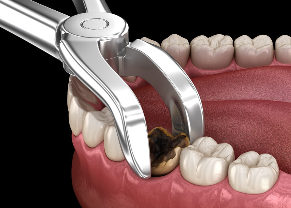 Teeth Extractions