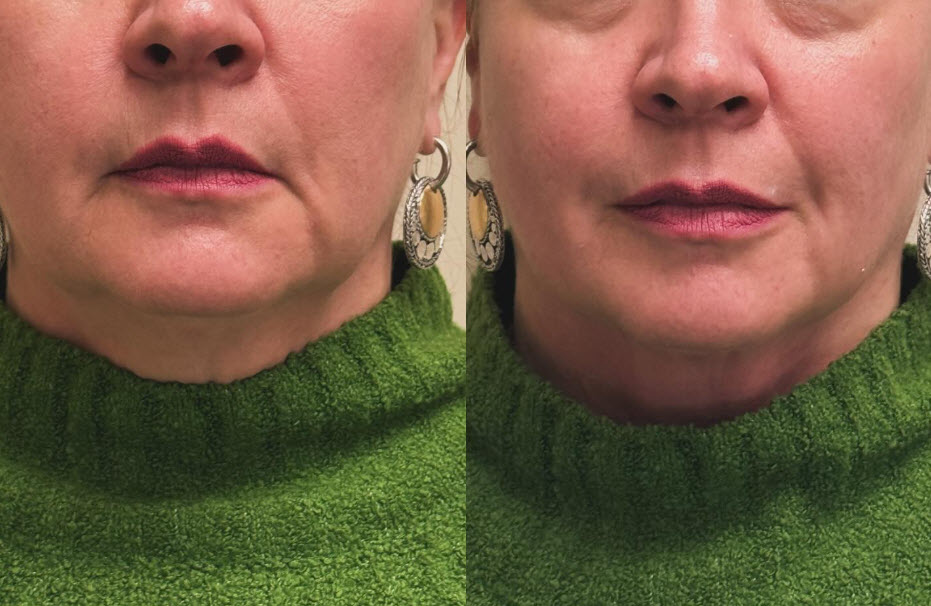 Jowls RF Treatment
