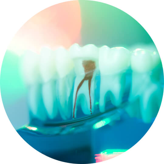 Root Canal Therapy