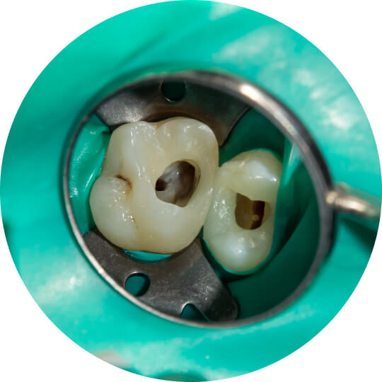 Endodontic Retreatment