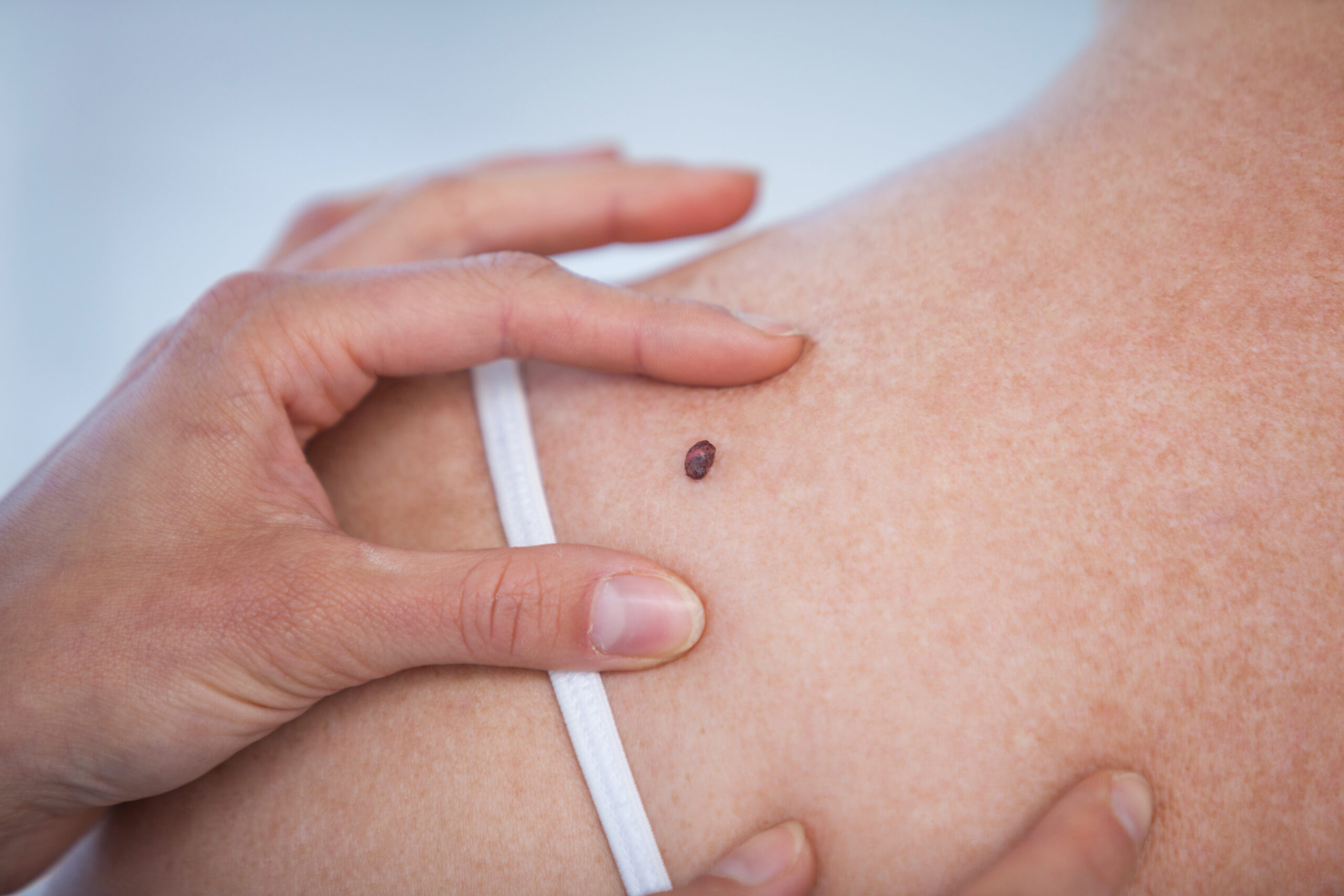 Skin Cancer