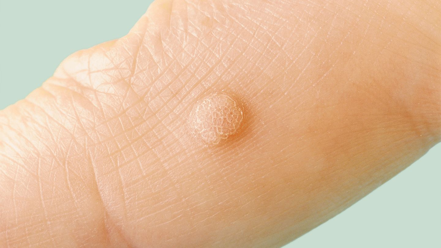 Warts