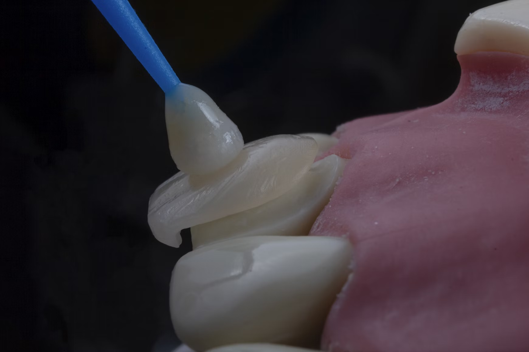 Soft Tissue Grafting for Implants