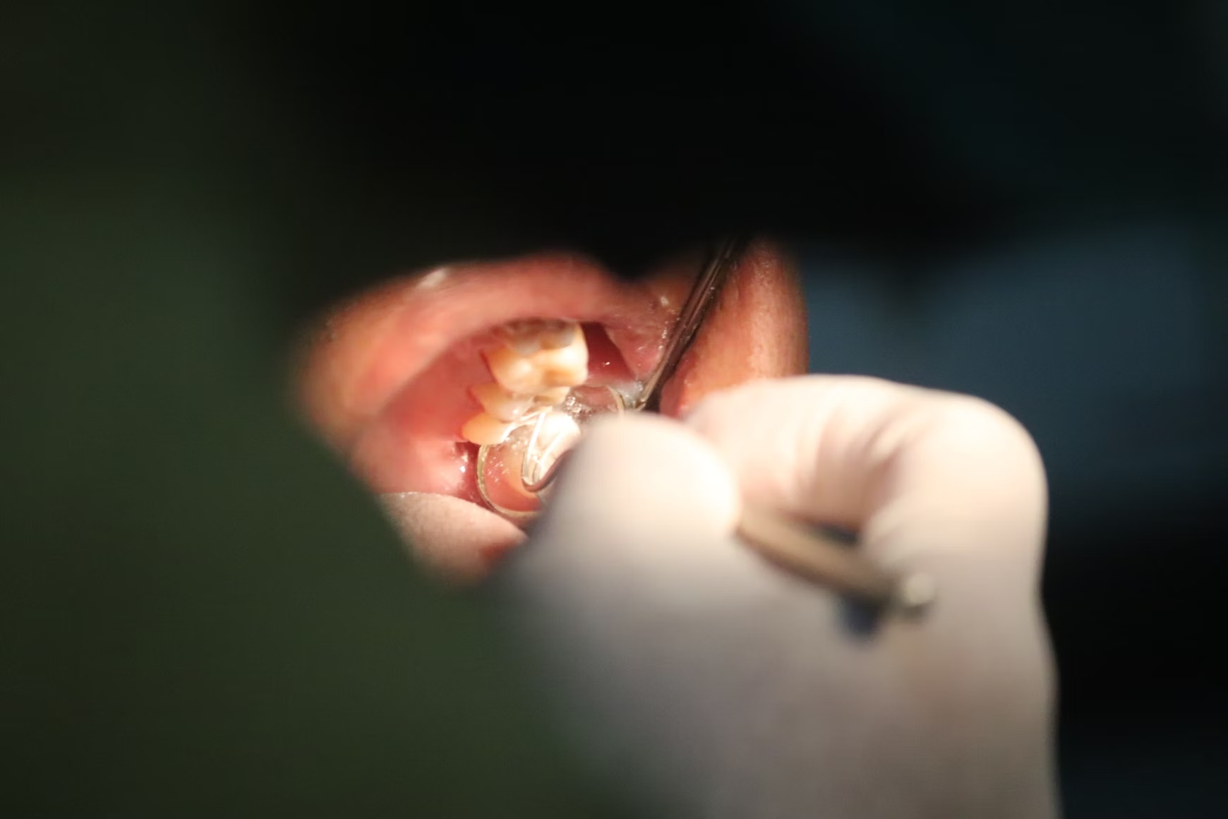 Wisdom Teeth Removal