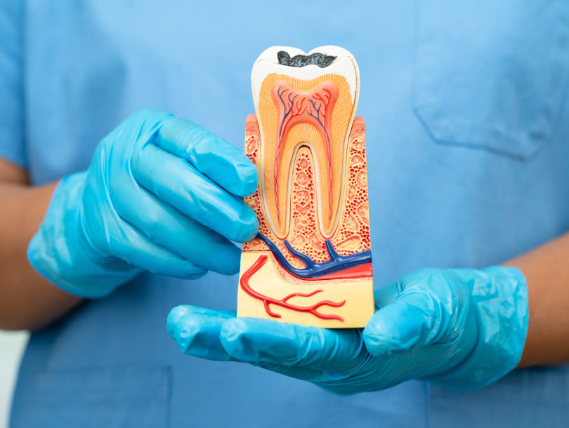 Root Amputation