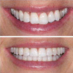 Invisalign