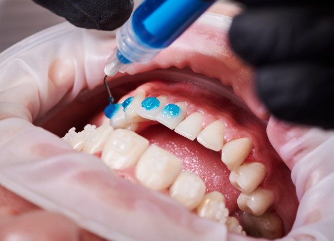 Teeth Whitening