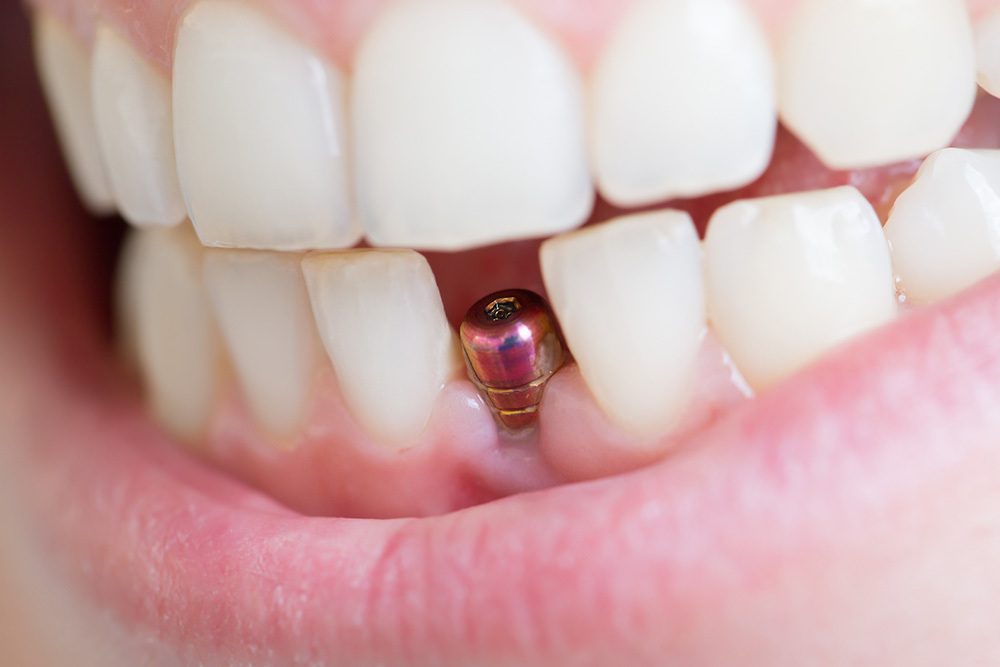 Implant Dentistry