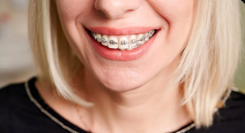 Metal Braces