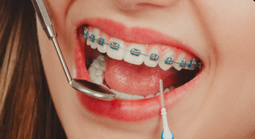 Orthodontic Emergencies