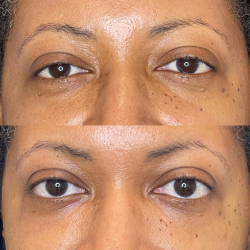 Chemical Peels