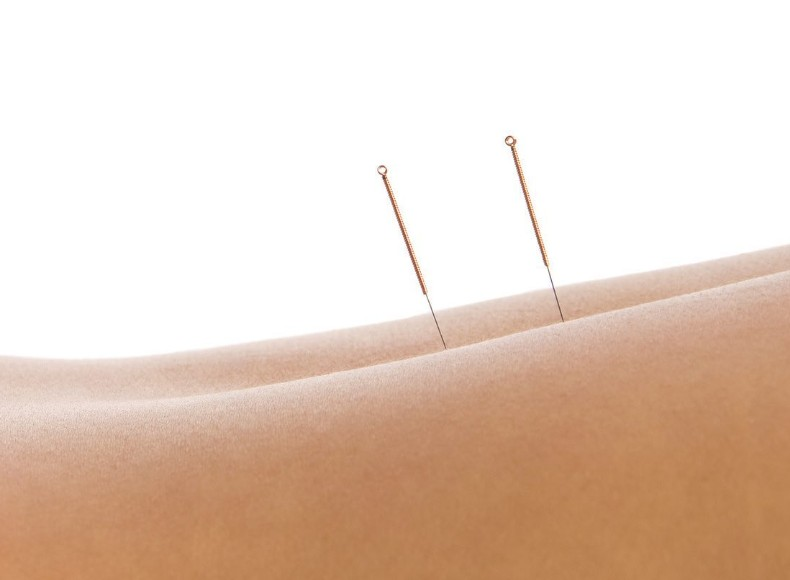 Acupuncture