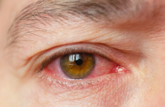 Pink Eye