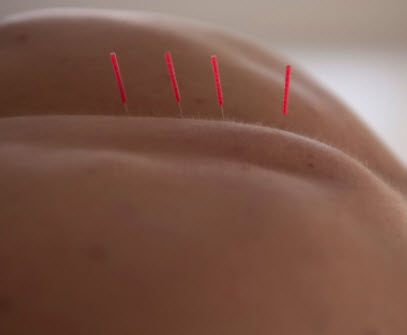 Dry Needling 