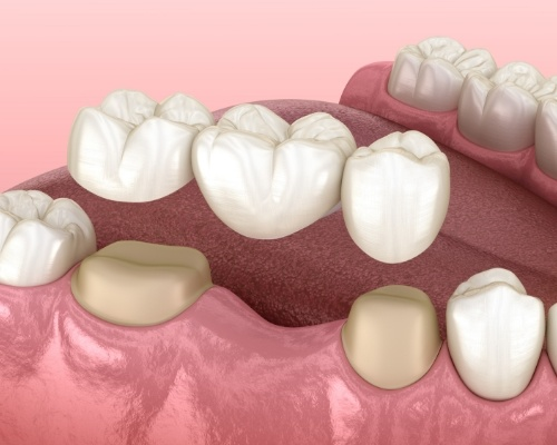 Dental Bridges