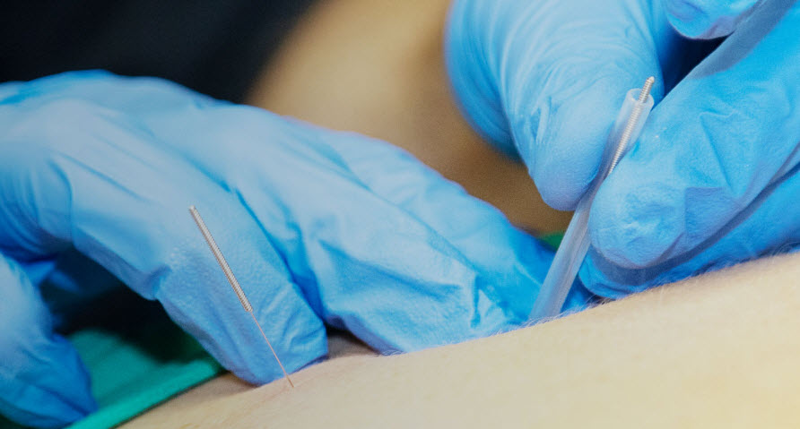 Dry Needling