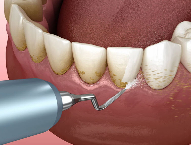 Teeth Cleaning (Prophy)