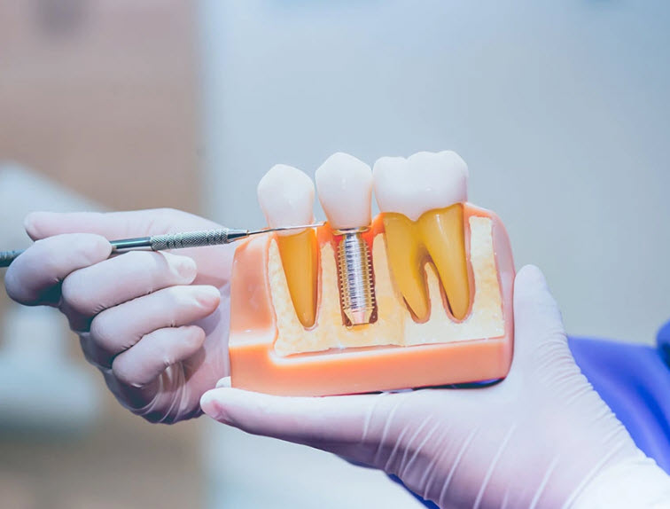 Dental Implants