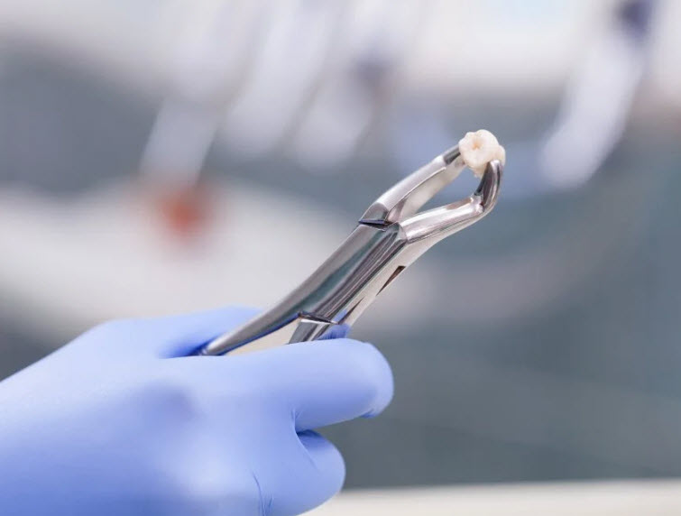 Tooth Extraction