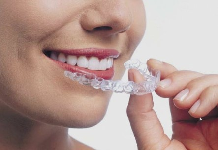 Invisalign