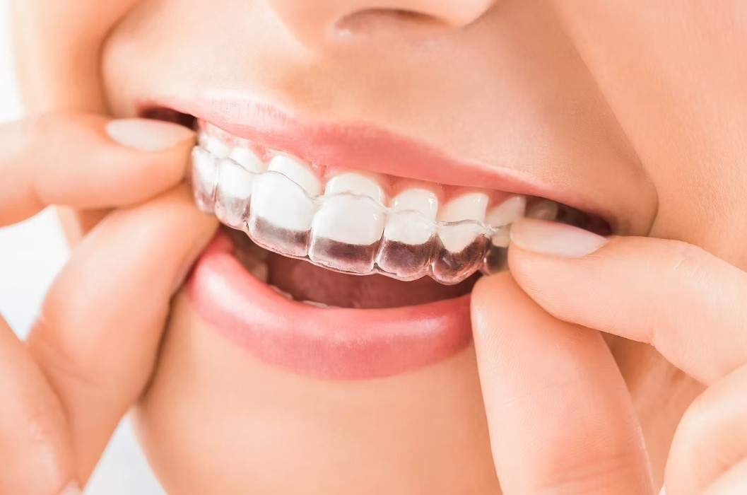 Invisalign